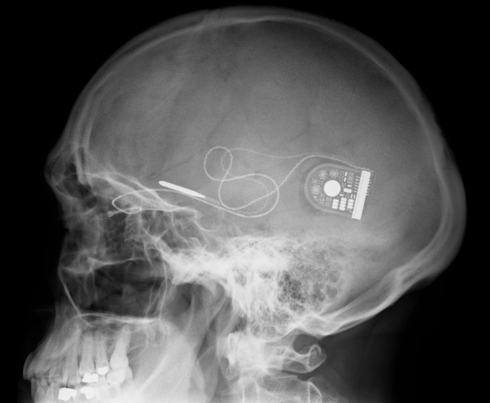 Hacking Brain Disorders Using Neural Implants