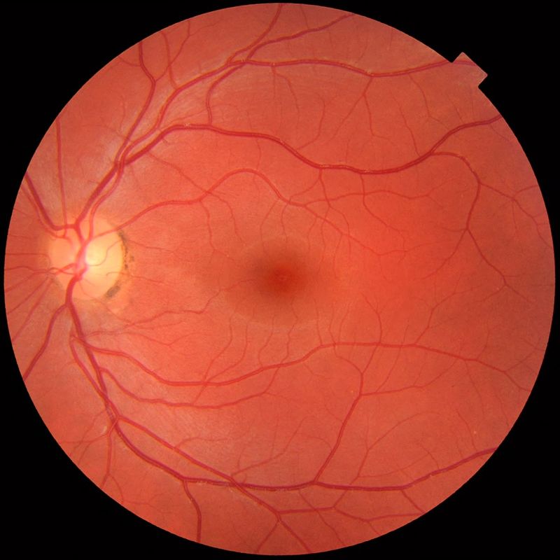 Simple Eye Test Can Spot Parkinson’s Disease Symptoms