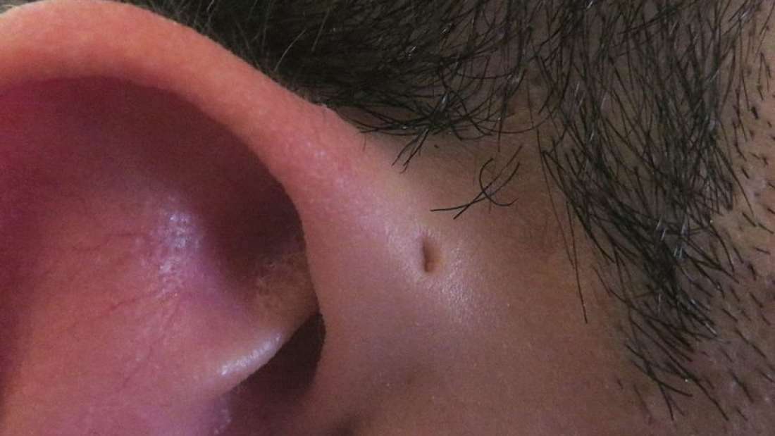 This is Why Some People Have Tiny Holes Above Their Ears