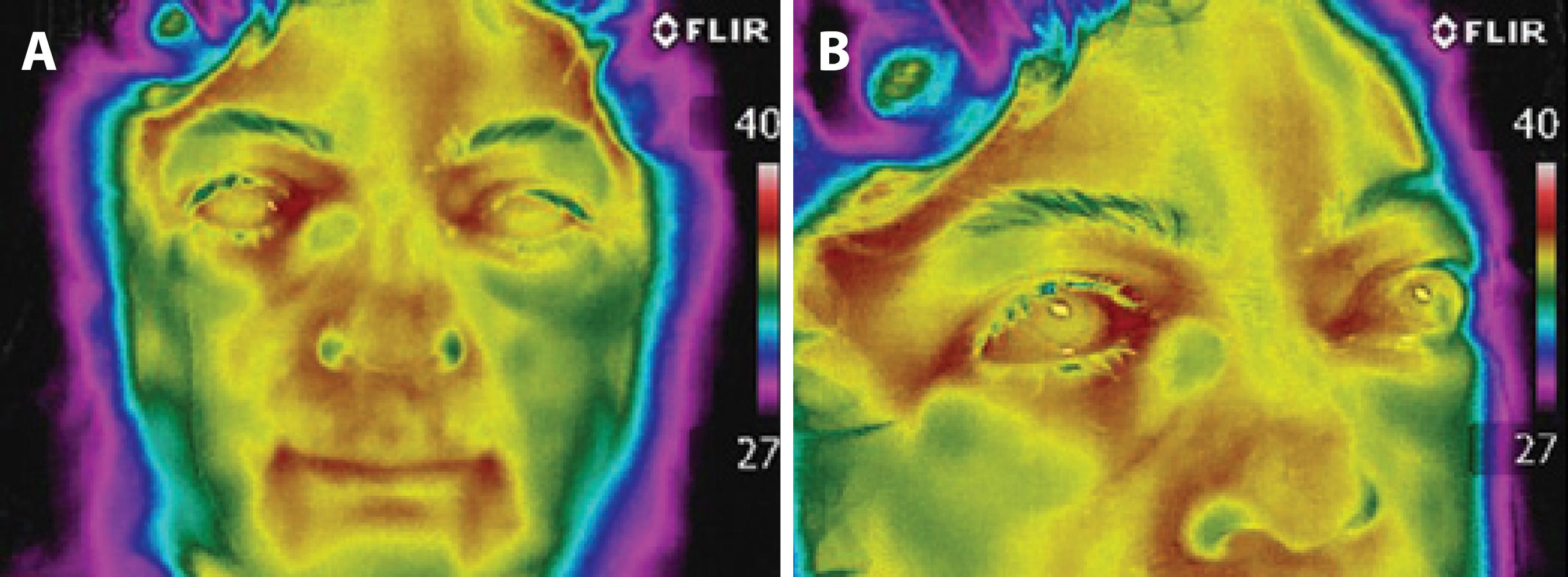 Thermal Imaging Assists Surgical Procedures