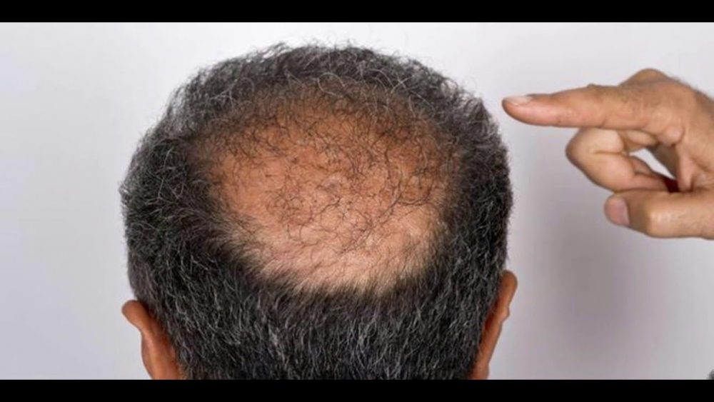 Hair Loss? Stem Cell Therapy Brings Hope