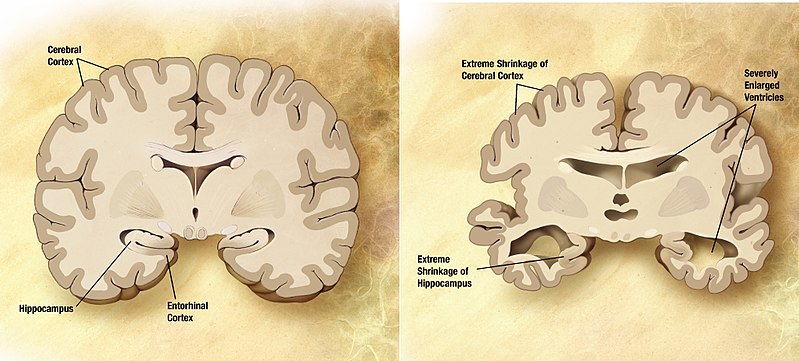 Link with circadian clock could solve the mystery of Alzheimer’s disease