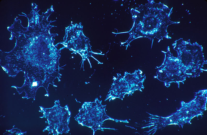 New Study Reveals That Cancer Cells Eat Themselves to Survive