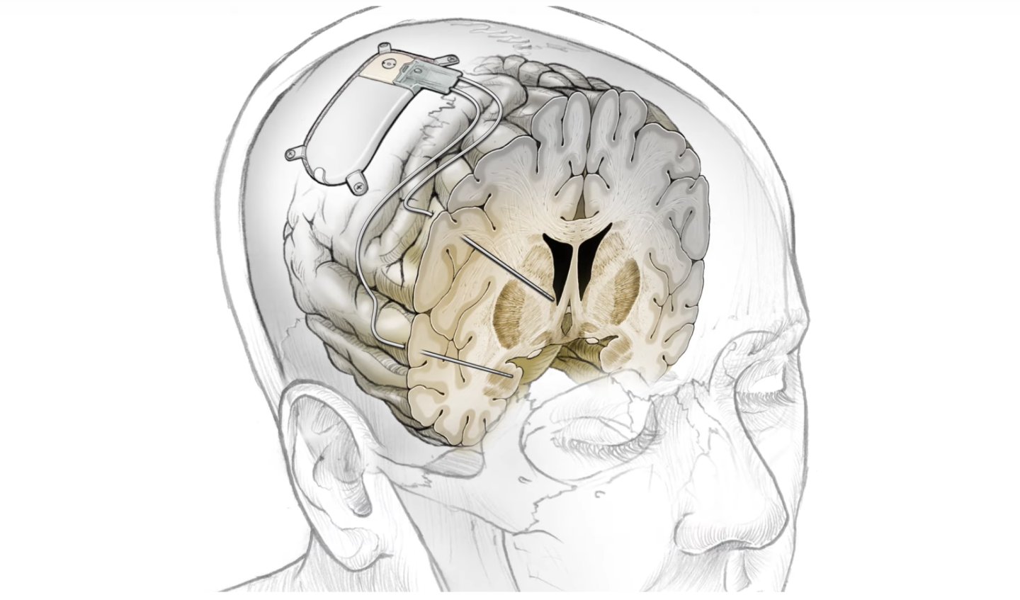 A Custom Brain Implant ‘Zaps’ Away a Woman’s Severe Depression