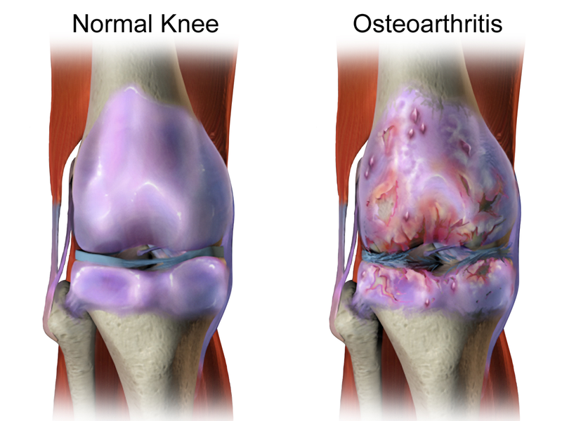 Scientists Develop a Gel to Inject Directly To Damaged Joints to Treat Osteoarthritis