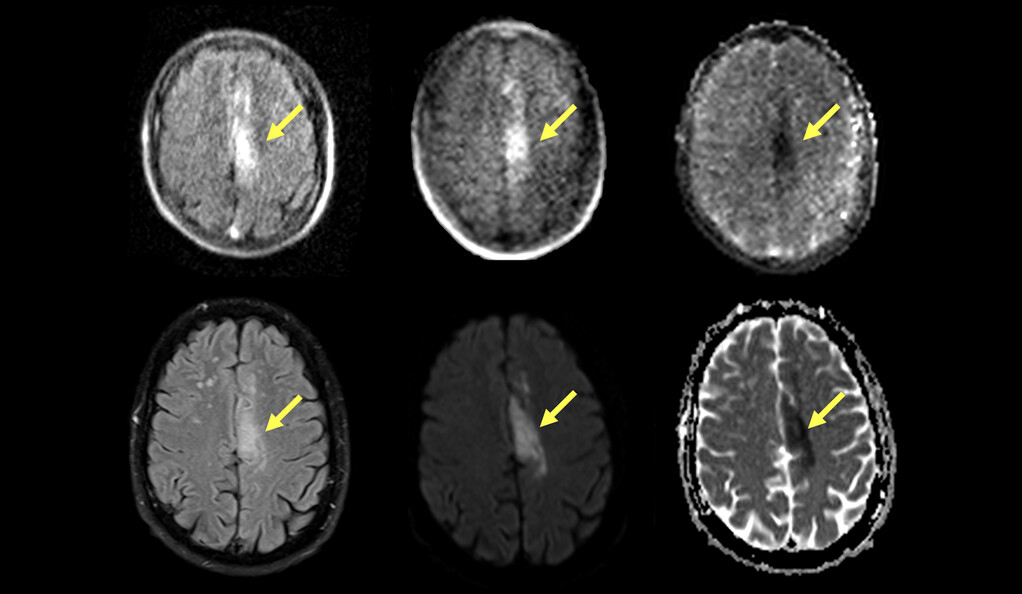 Now Strokes Can Also Be Detected Using Portable MRIs Almost As Effective As Standard MRIs
