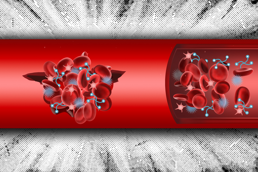 MIT Engineers Create Injectable Synthetic Blood Clots to Halt Internal Bleeding to Save Lives