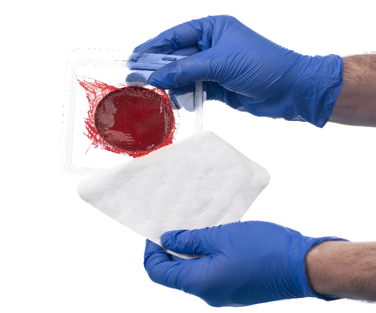 Goodbye Bandages: Breakthrough Technology Harnesses Patient’s Own Blood to Heal Chronic Wounds