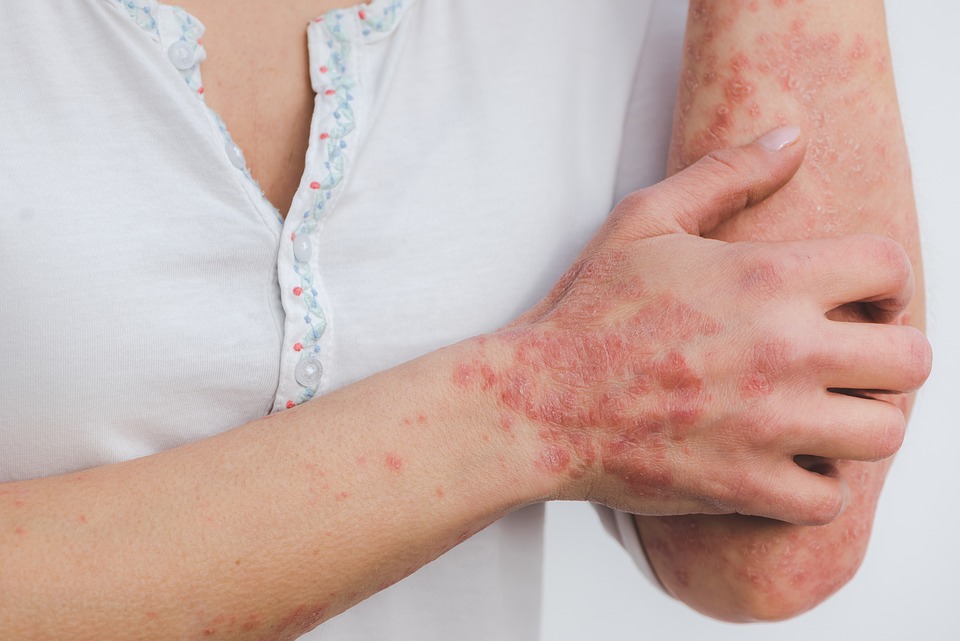 New Studies Uncover Effective Treatments for Eczema
